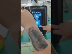 P9 Nd Yag Laser Picosecond Laser Tattoo Entfernung Gerät