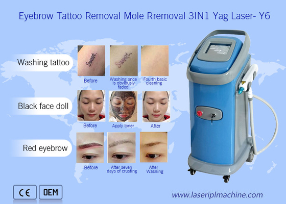 1064nm 532nm Nd Yag Laser Tattoo Entfernung Maschine Dermatologie